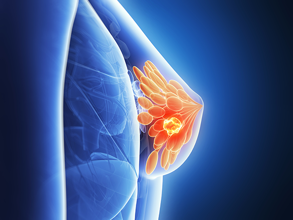 breast cancer treatment de-escalation